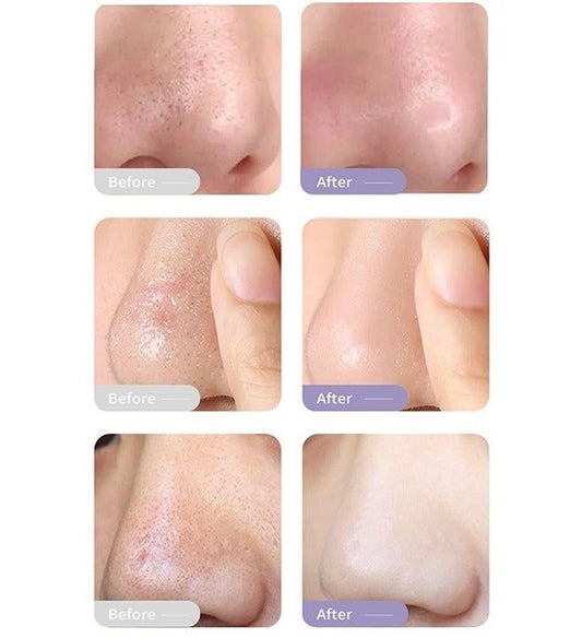 BLACKHEAD REMOVING KIT